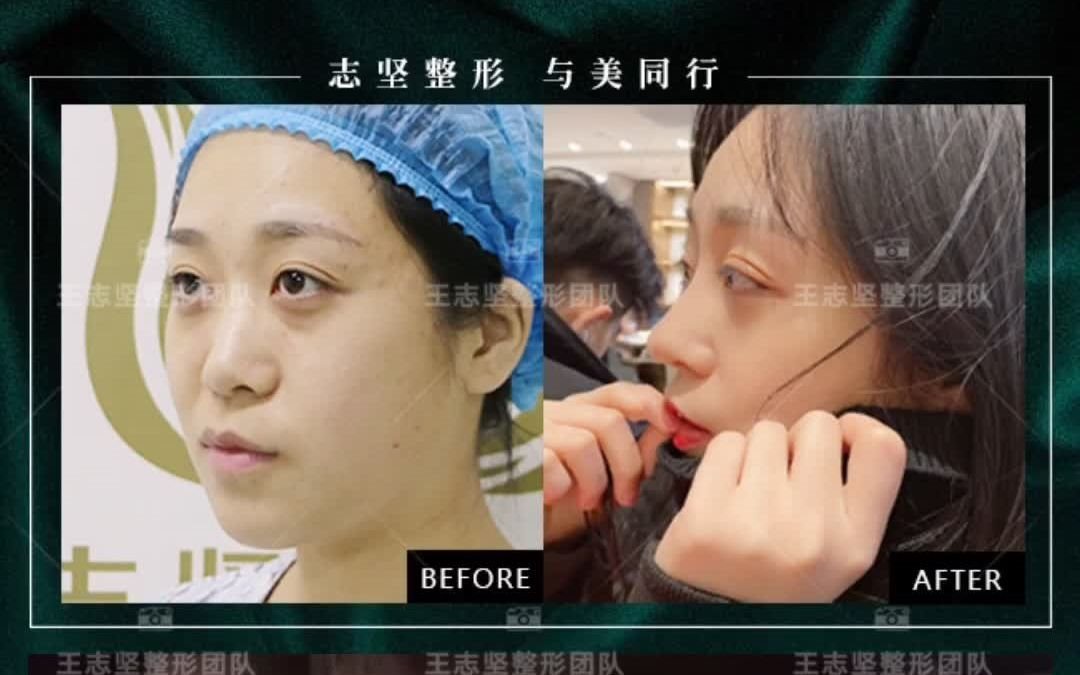 王志坚院长鼻整形术后半年案例分享