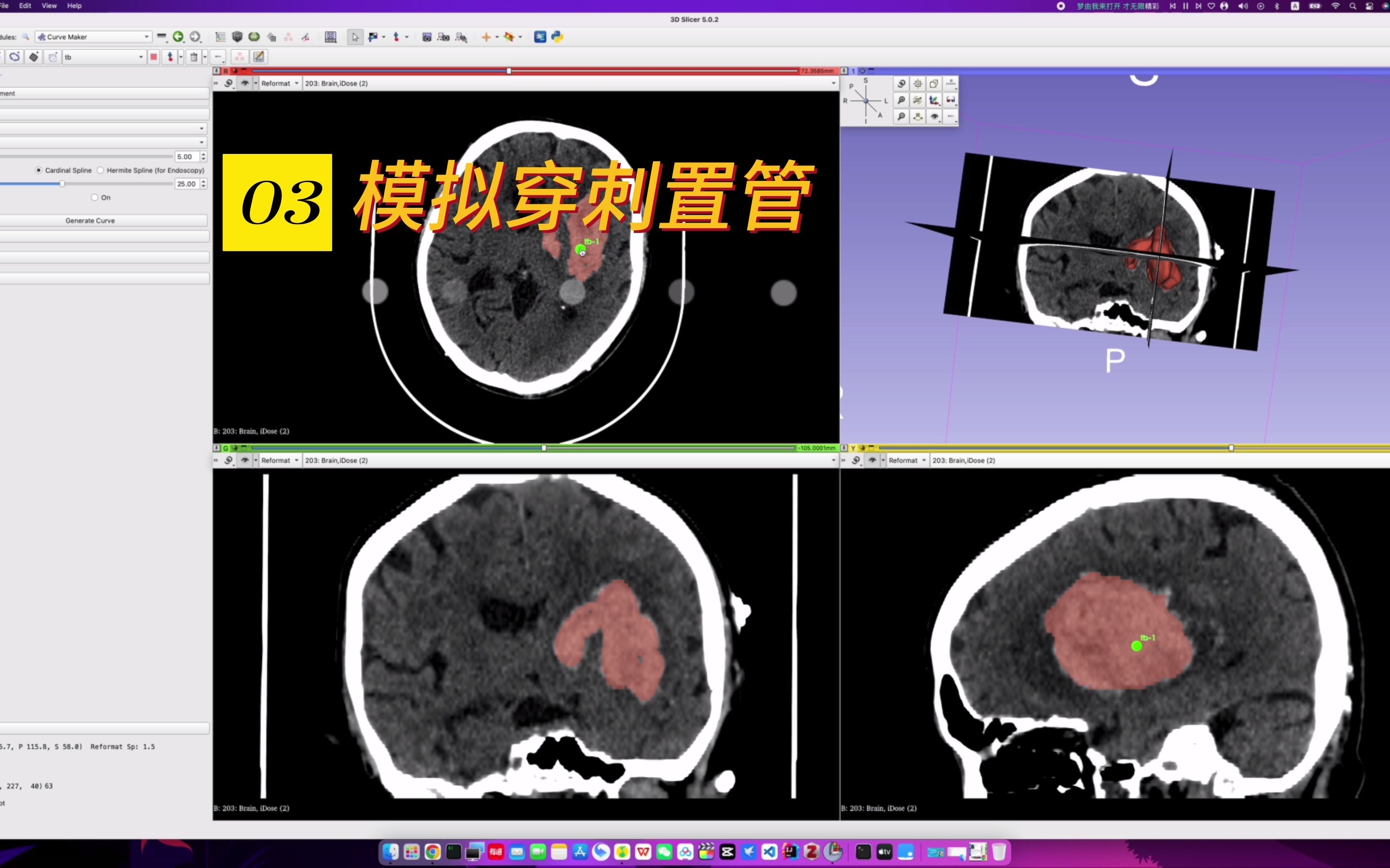 脑出血微创穿刺置管外引流手术,老手术,新看法哔哩哔哩bilibili