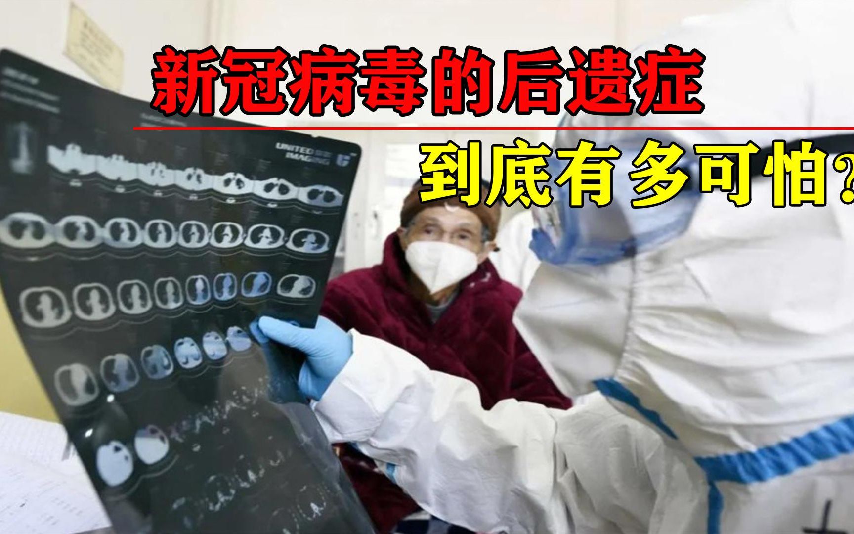 新冠后遗症有多恐怖?武汉协和医院新研究,治愈一年后仍深受其害哔哩哔哩bilibili