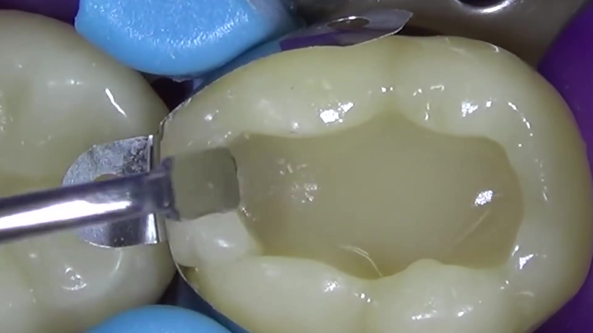 牙齿有个大洞别着急千万别拔树脂补牙了解下