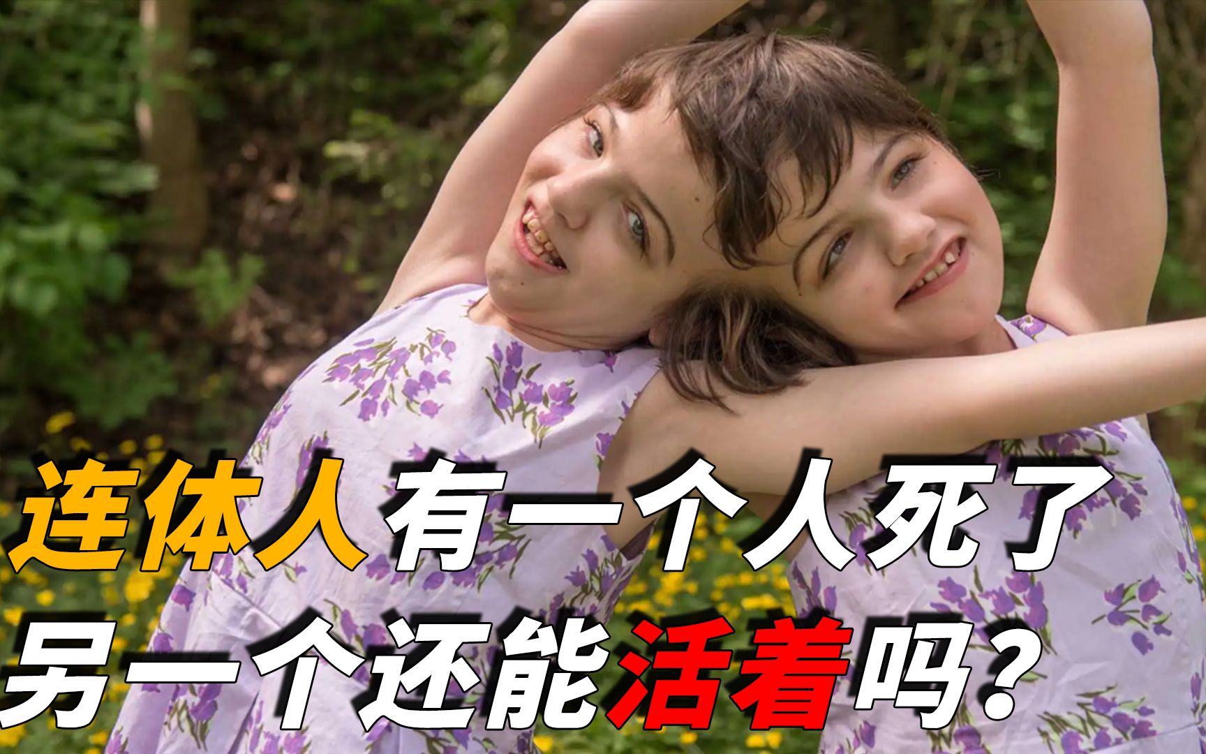 如果连体人有一个死了,那另一个还能活着吗?答案或超出你想象