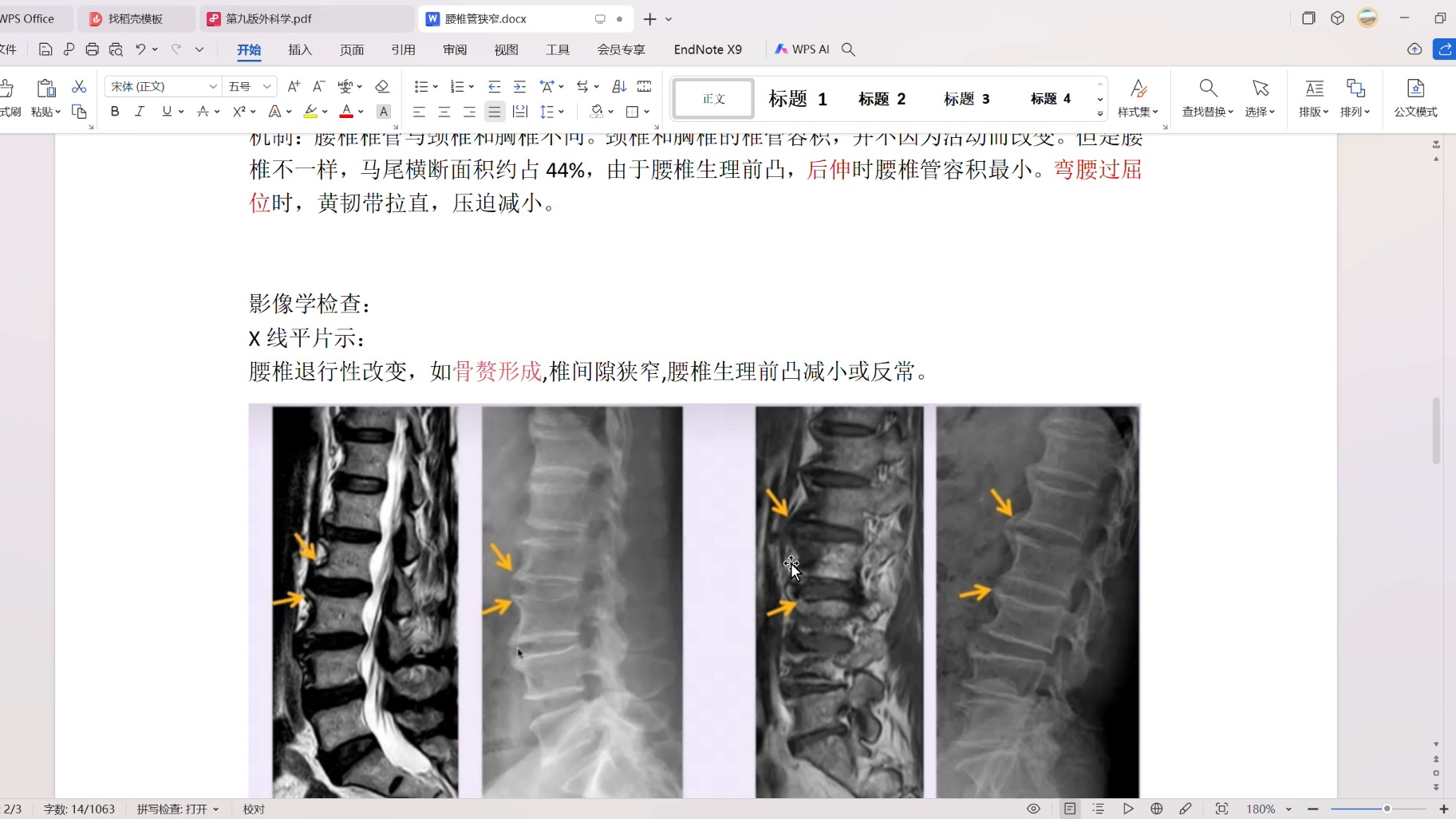 脊柱外科之腰椎管狭窄