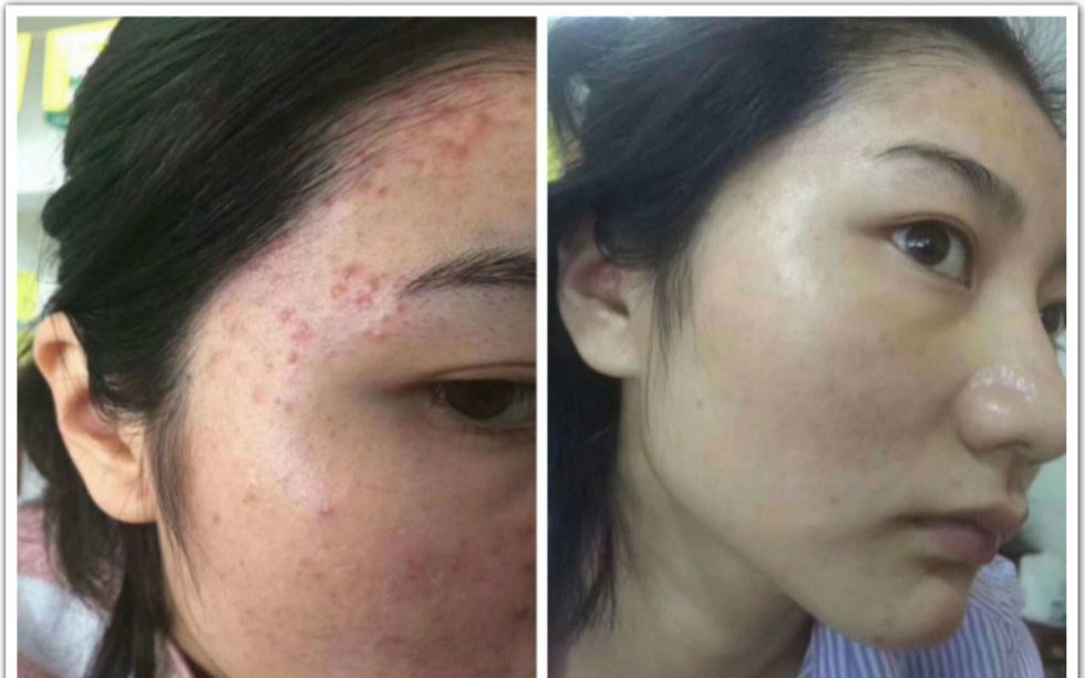 科普痘痘肌肤的内忧外患(3)_去痘的最快方法