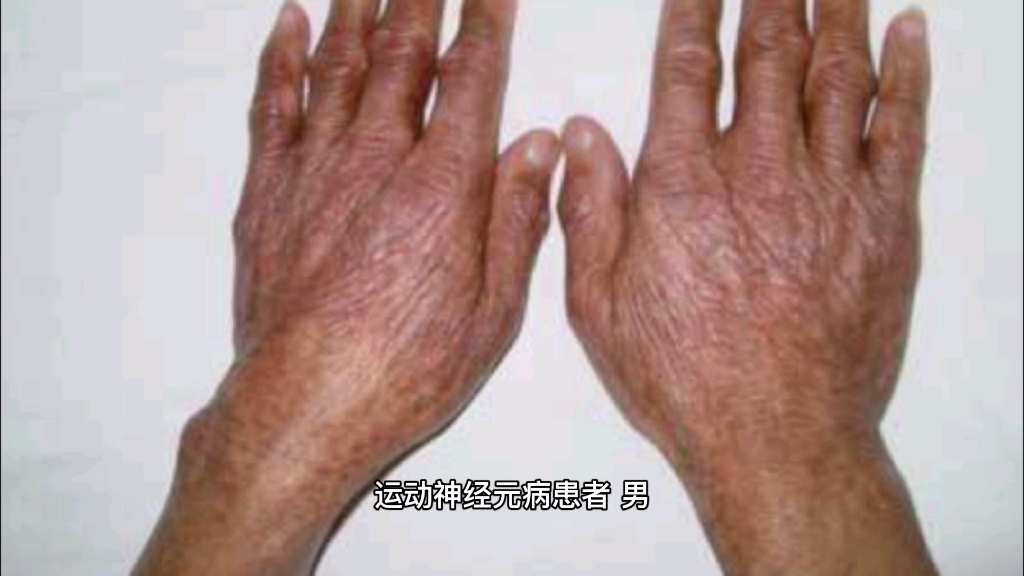 运动神经元有希望了