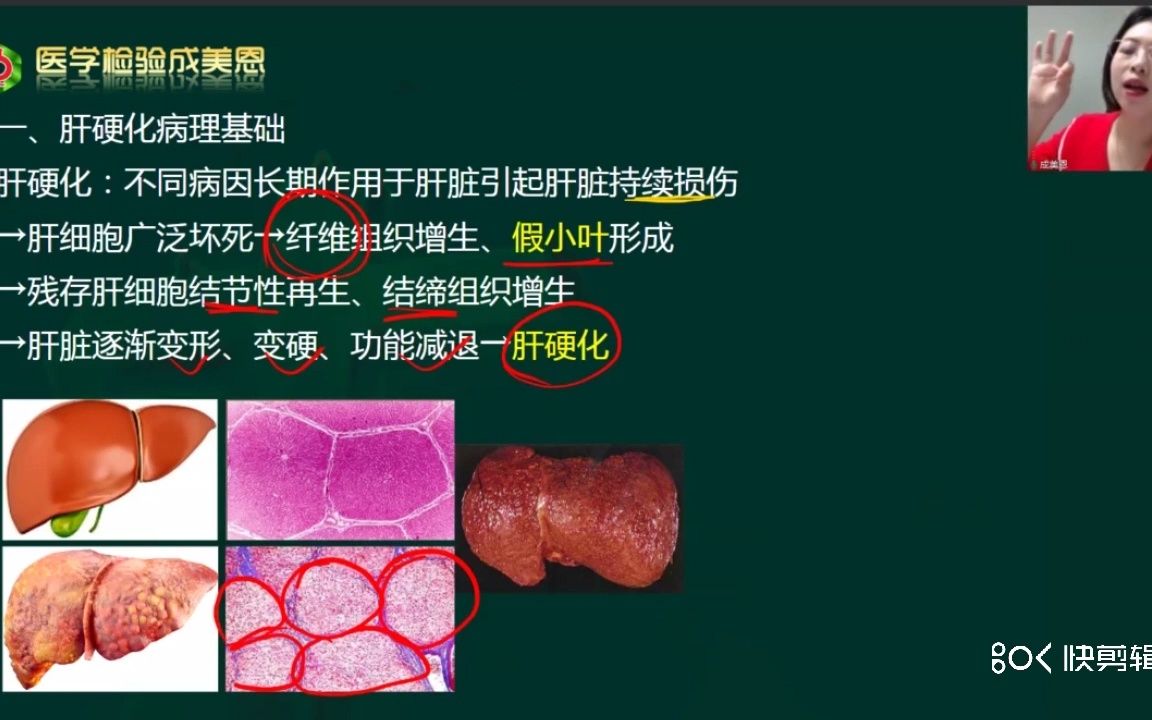 [图]什么是肝硬化？——医学检验成美恩