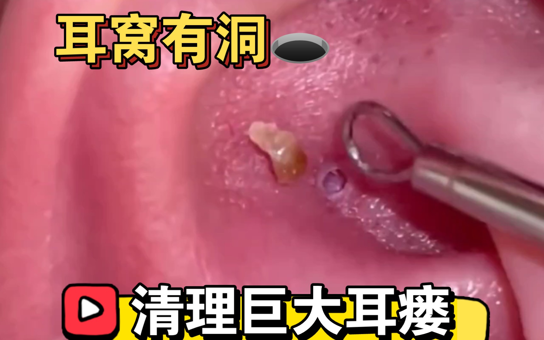 【沉浸式体验】深层黑头清除|耳瘘|皮肤管理|解压清洁|面部护理|爆浆