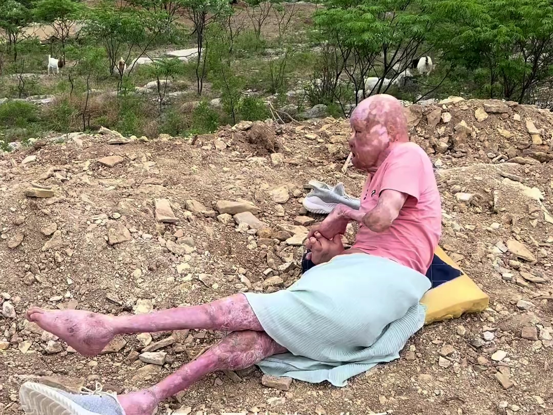 就算被大火烧伤也改变不了我阳光的一面!