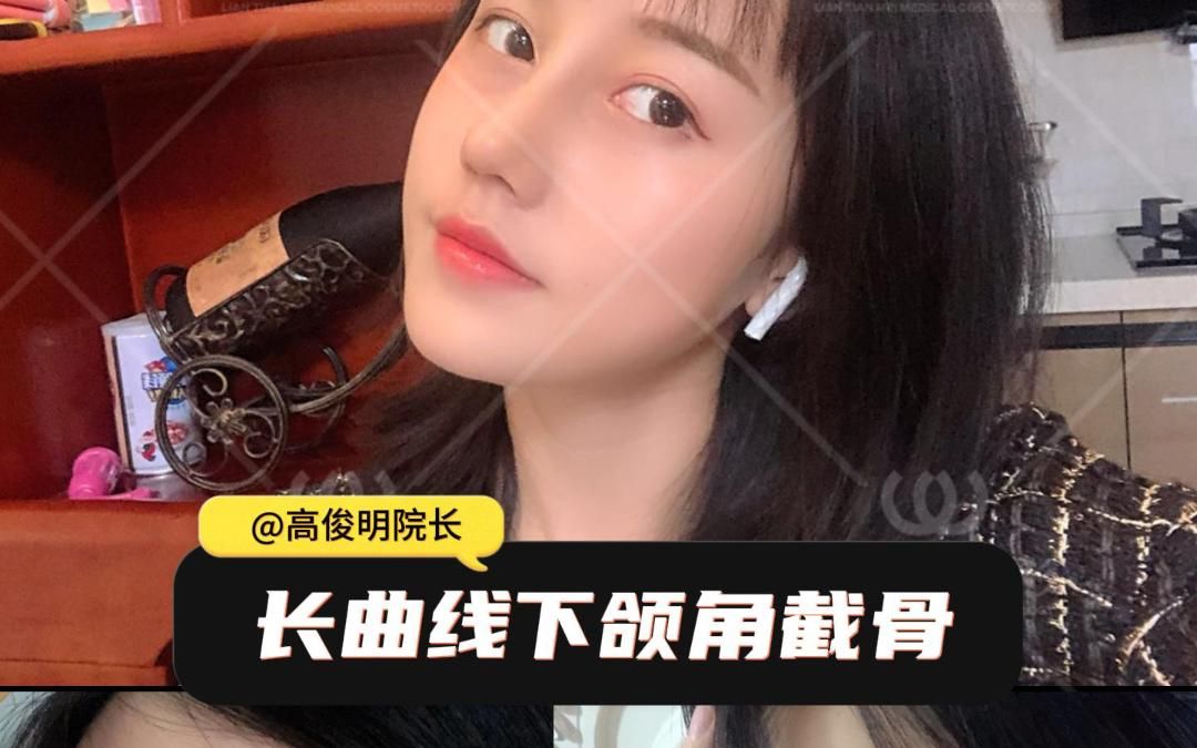 高院长-长曲线下颌角截骨案例