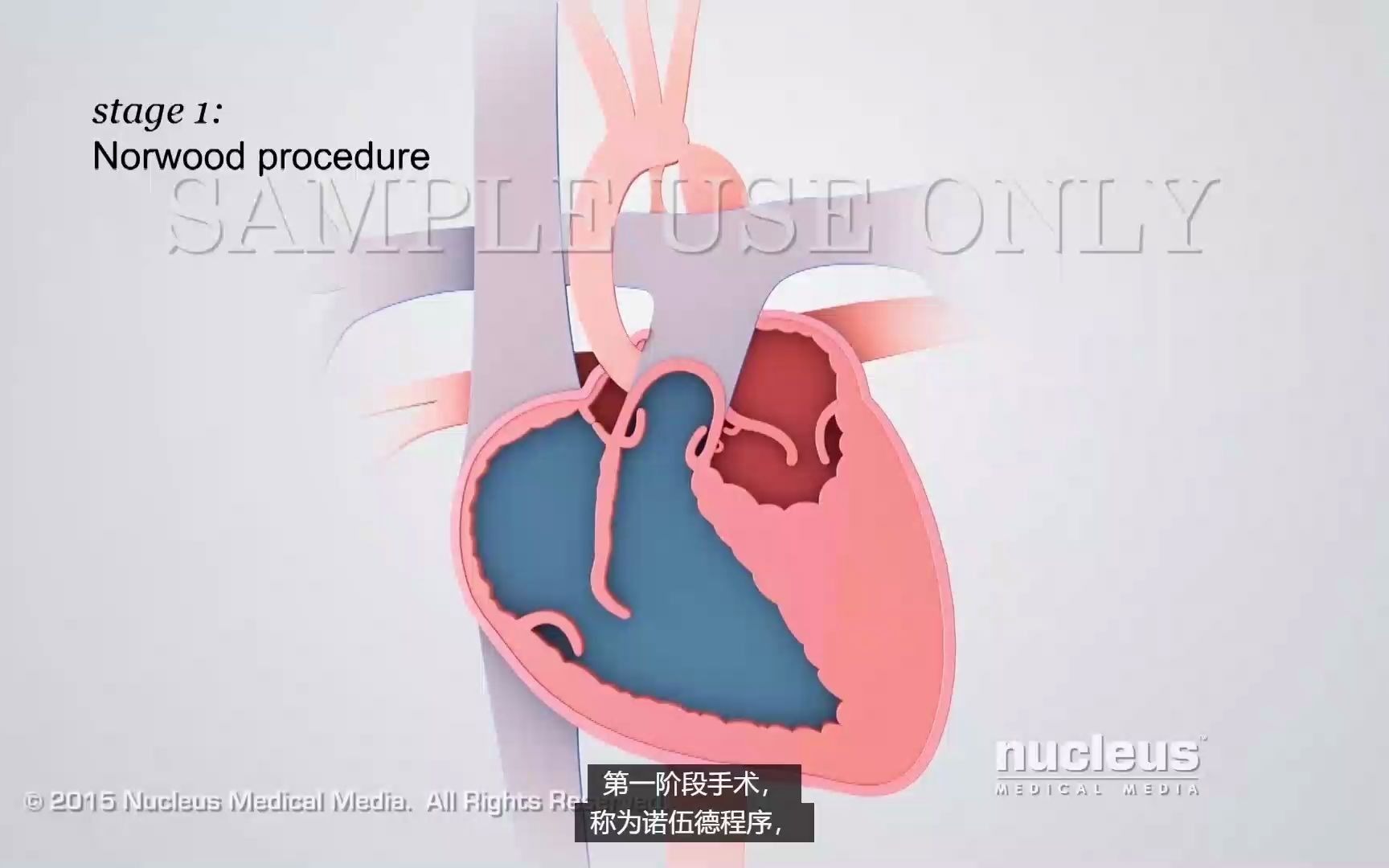 左心发育不全综合征(单心房单心室)哔哩哔哩bilibili