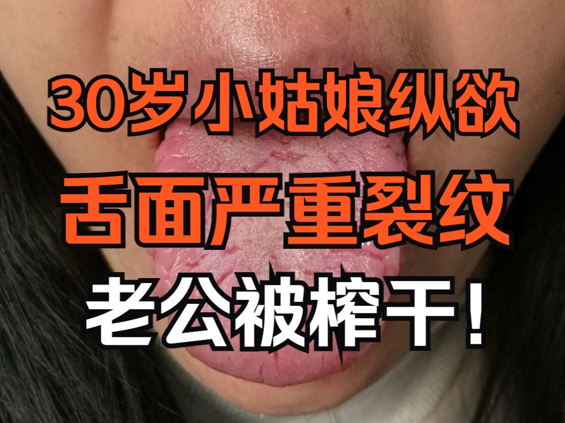 30岁小姑娘欲望大,爱看小电影纵欲过度,导致舌面严重裂纹!哔哩哔哩bilibili