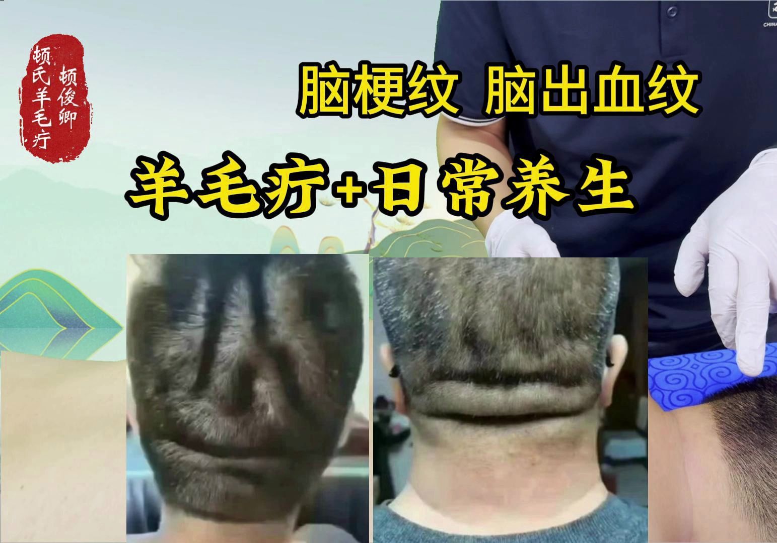 后脑勺脑梗纹 脑出血纹 怎么调理?顿俊卿羊毛疔