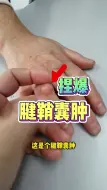 Download Video: 捏爆腱鞘囊肿