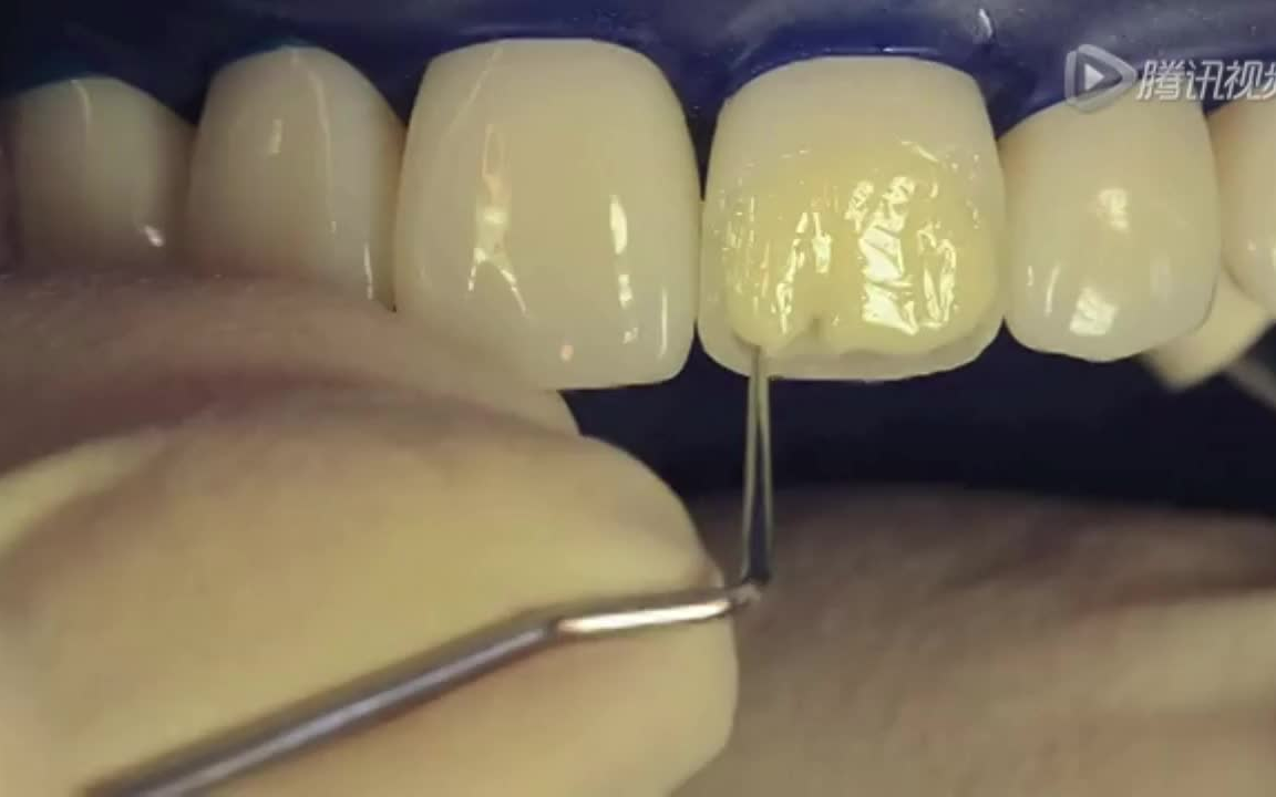 【高清纪实】两分钟看完树脂补牙全过程,慢工出细活!_哔哩哔哩_bilibili