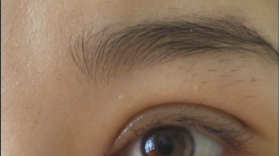 全切双眼皮 开内眼角第四天 无美颜无滤镜 眼睛周围已经泛黄