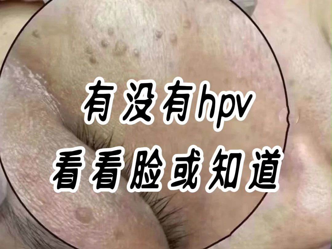 有没有hpv,看看脸或知道