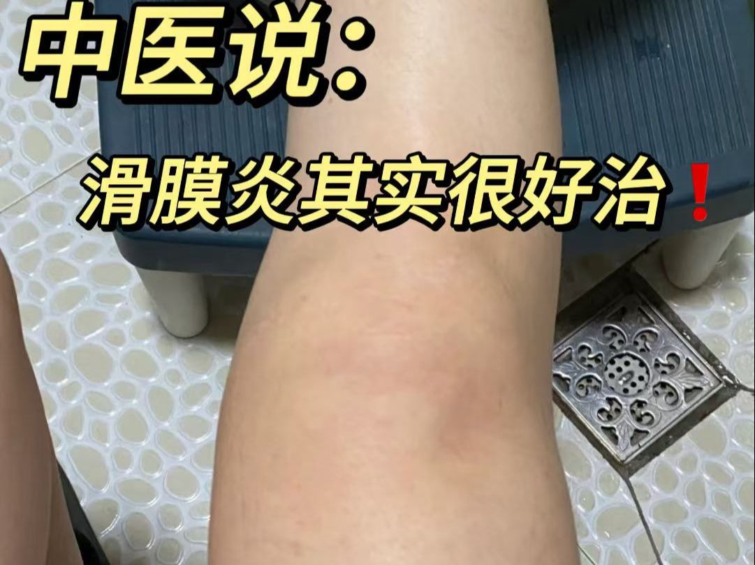 滑膜炎:从膝盖发疼有积液到膝关节可以自由活动,只花了28天!