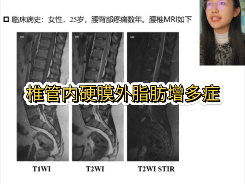 椎管内硬膜外脂肪增多症(SEL):硬膜外脂肪在椎管内病理性增生,好发于腰骶部.病例来源:https://doi.org/10.53347/rID185295哔哩哔哩bilibili