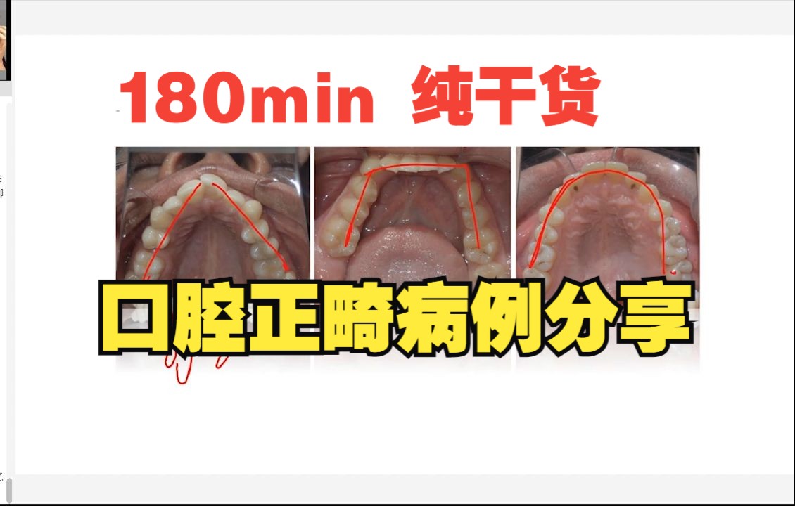 口腔正畸病例分享,180min纯干货,建议保存收藏哔哩哔哩bilibili