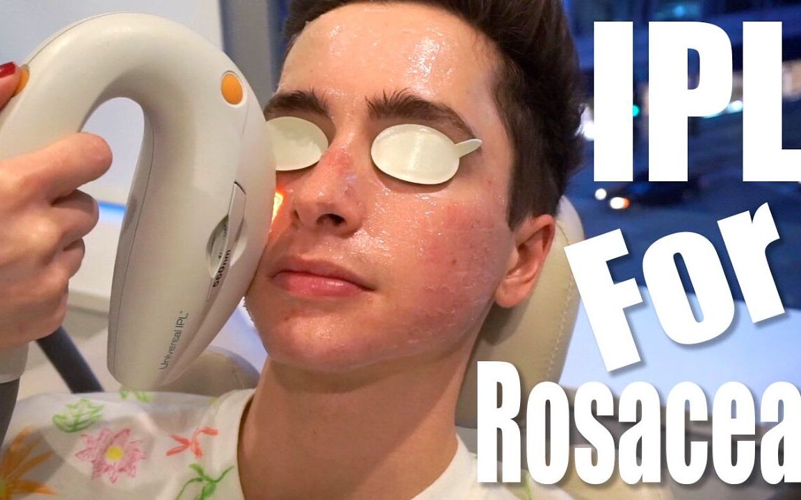 Rosacea Treatment with IPL Laser哔哩哔哩bilibili