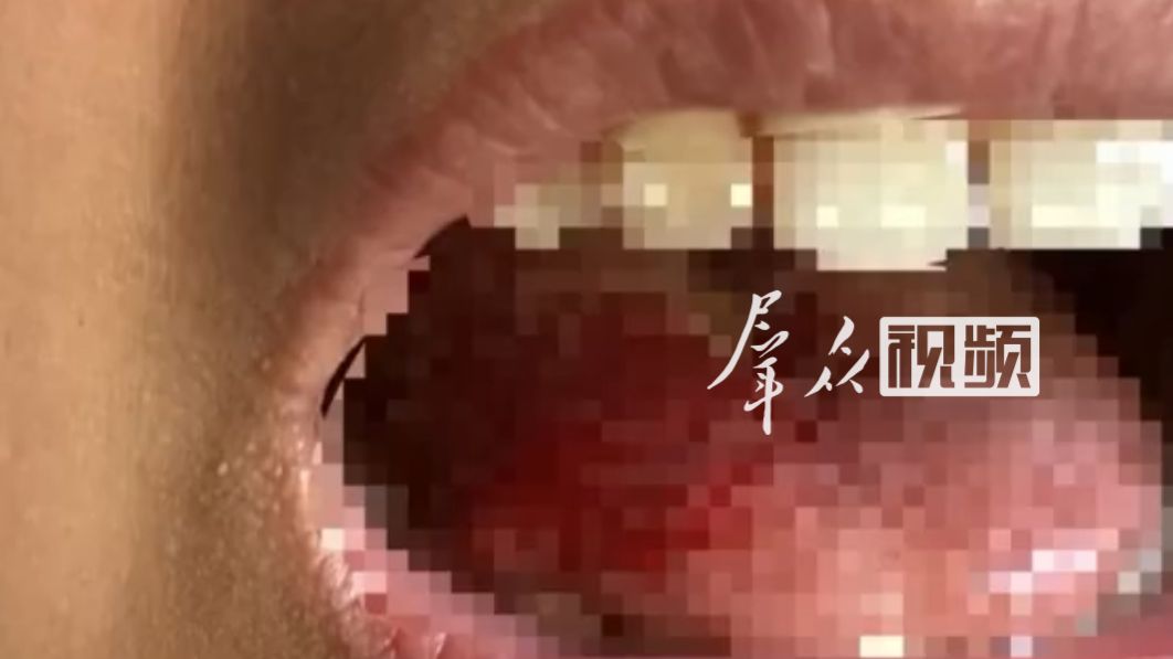 游客在网红餐厅就餐吃出玻璃碎片，口腔上颚被划破出血。涉事门店：正配合相关部门调查，联系客人积极协商。