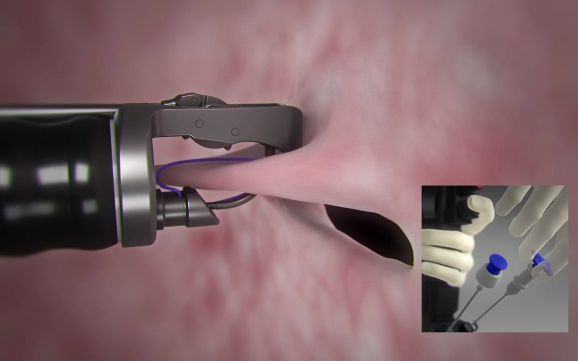 overstitch64 内窥镜缝合系统