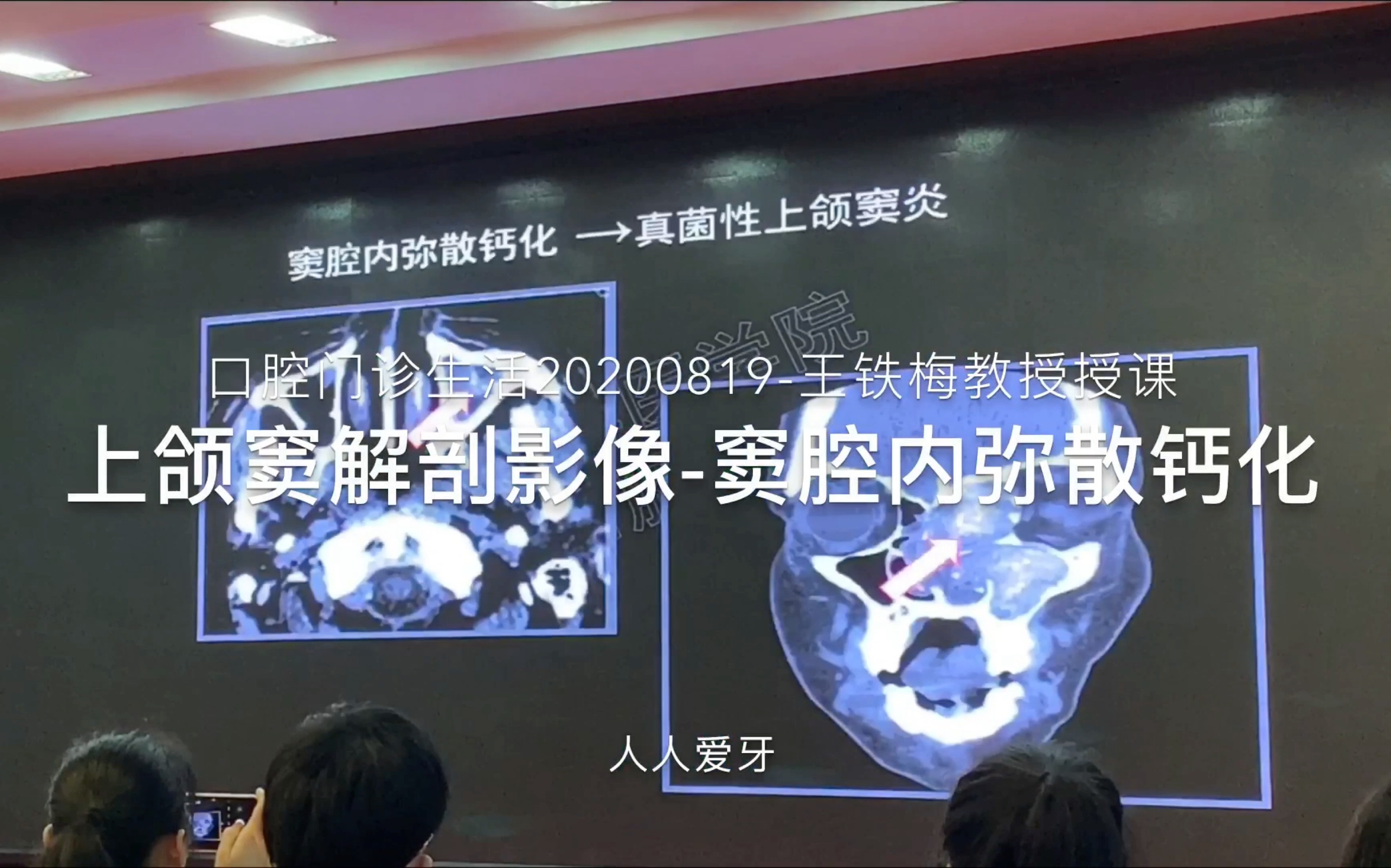 上頜竇解剖影像竇腔內彌散鈣化口腔門診生活20200819