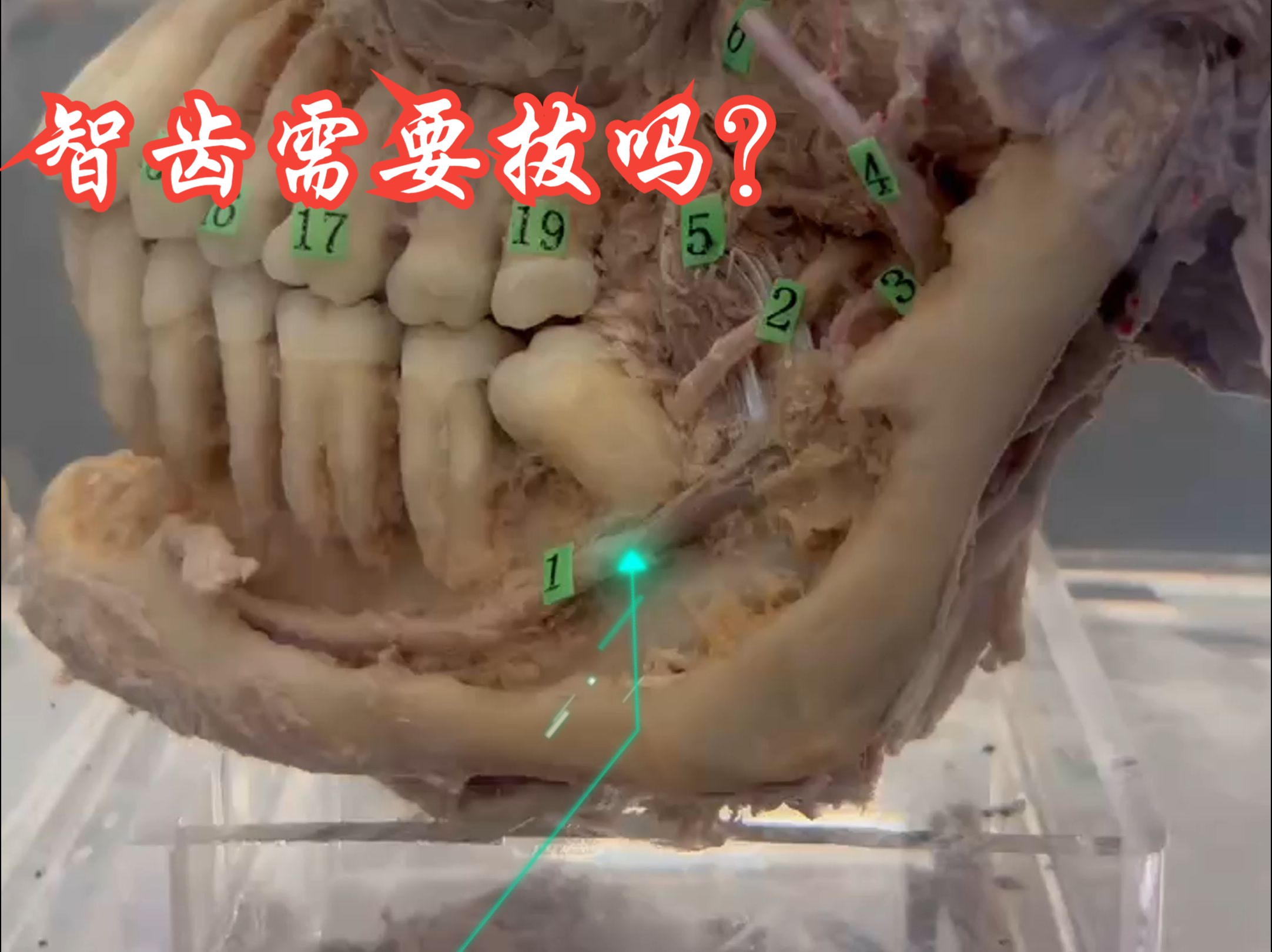 智齿,需不需要拔除?看完这个希望您有答案哔哩哔哩bilibili