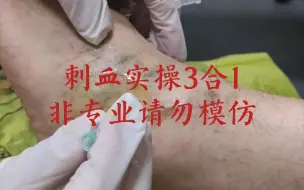 下载视频: 刺血三合一