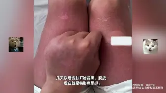 Download Video: 女子涂防晒霜在海边玩一整天，回家后竟开始发红脱皮，白做防护？