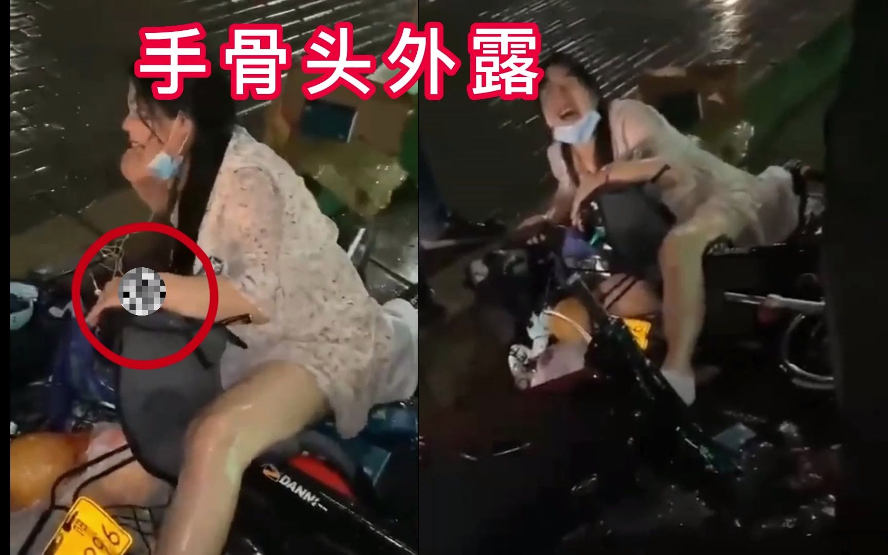 [图]这车速得多块？妹子手骨头惨被外露，骨棒都出来了