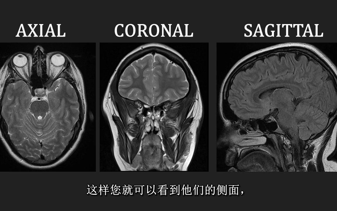 简单学会看颅脑核磁哔哩哔哩bilibili