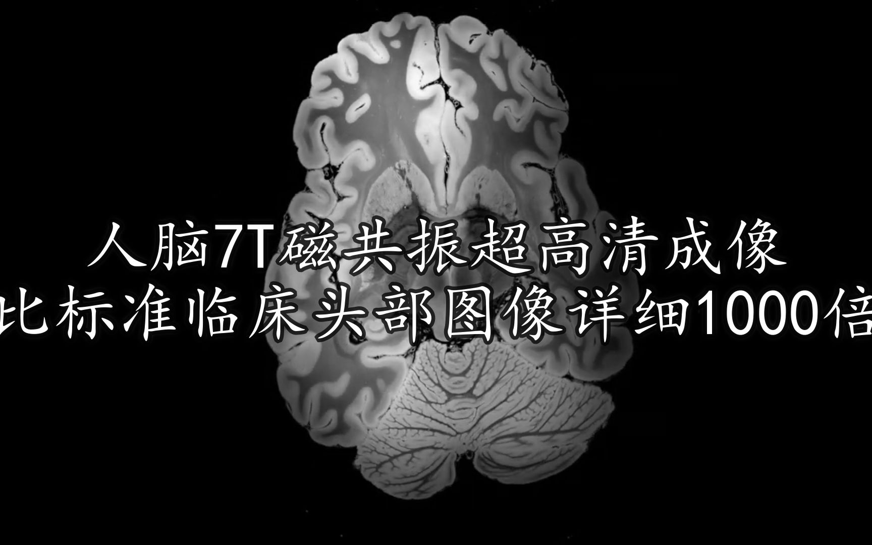 迄今为止最完整最高清人脑的7T磁共振成像,比临床头部图像详细1000倍哔哩哔哩bilibili