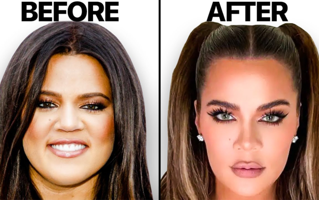 Khloe Kardashian|koko的脸发生了什么|整形手术分析哔哩哔哩bilibili