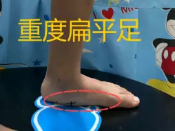 Download Video: 6岁男孩扁平外翻足、内八字步态。家长发现孩子步态异常，专程从清远过来测评定制。小朋友早期症状比较明显，应尽早到专业机构矫正，切勿错过最佳矫正时间[太阳]