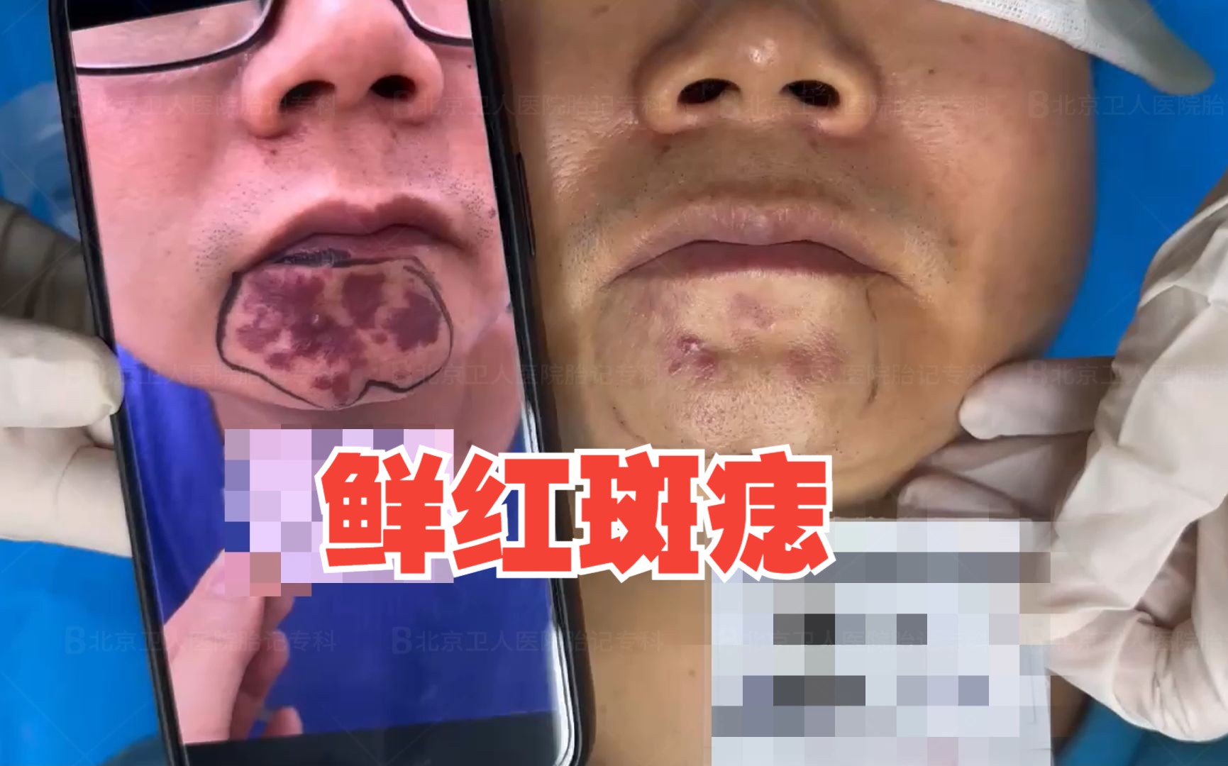 北京鲜红斑痣(红色胎记)医院排行榜/北京胎记医院/北京卫人中医医院