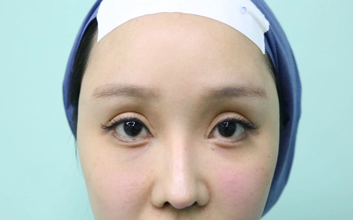 "欧式双眼皮"显假宽深,眼窝凹陷,该如何修复?_哔哩哔哩_bilibili