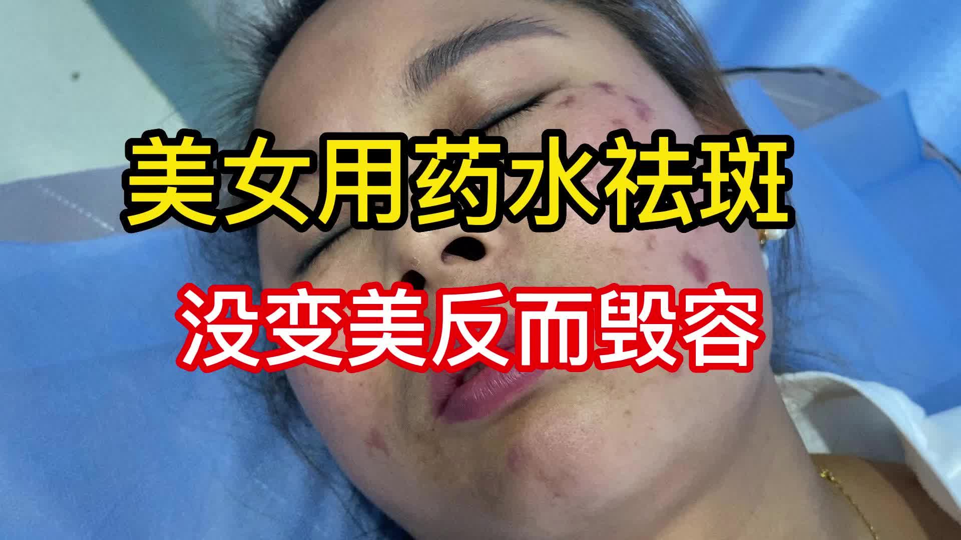 药水真的不能秒去斑,只能1秒毁容哔哩哔哩bilibili