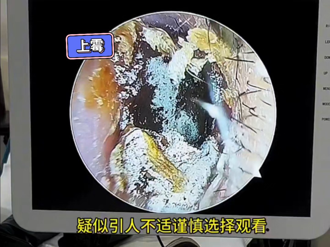 耳朵里面又痒又痛,里面感染了好像上霉一样