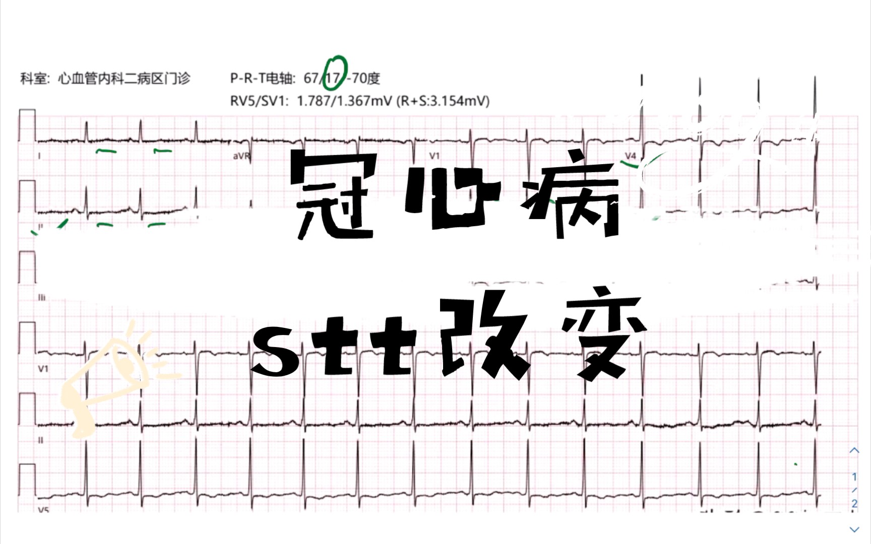 冠心病,stt改变哔哩哔哩bilibili