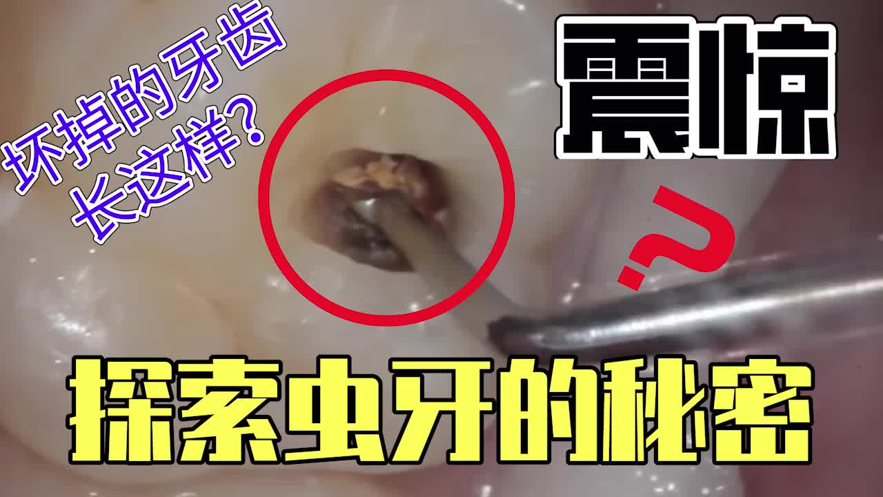 [图]【高清】探索虫牙的秘密，原来坏掉的牙齿长这样子？