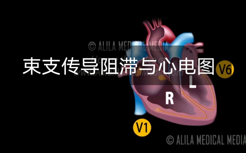 【Alila Medical Media】6.束支传导阻滞与心电图哔哩哔哩bilibili