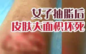 Download Video: 百姓关注【贵阳女子抽脂后，皮肤大面积坏死！医院：暂不考虑赔偿】