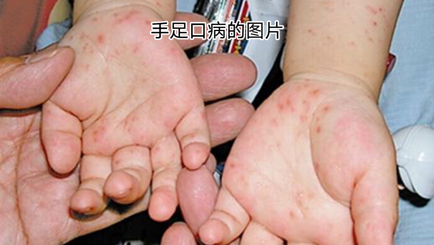 手足口病症状 初期图片