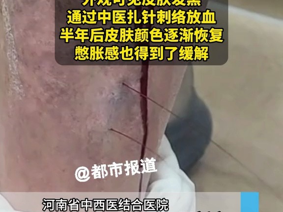 男子静脉曲张皮肤变黑，瘙痒溃疡，找中医扎针放血，半年后减轻很多