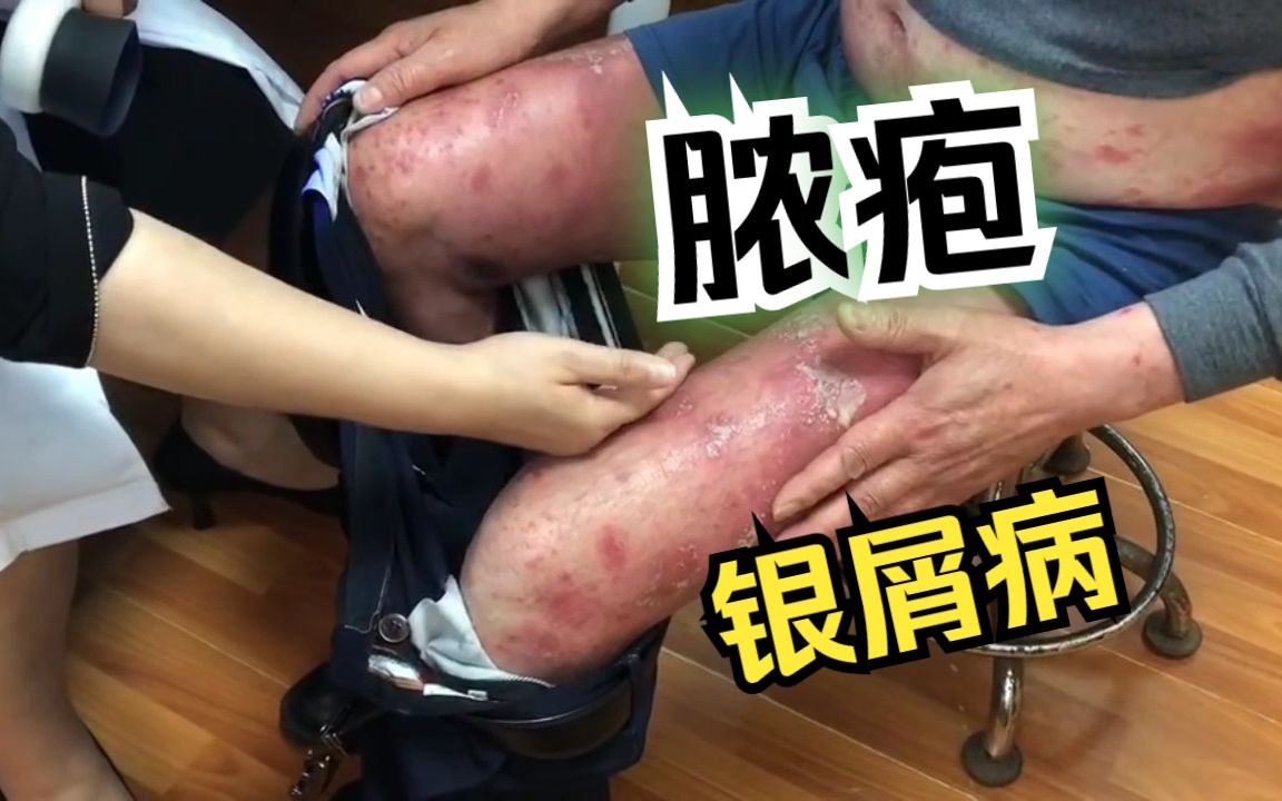 患者脓疱型银屑病,自诉腿部胀痛,发烫,行走困难