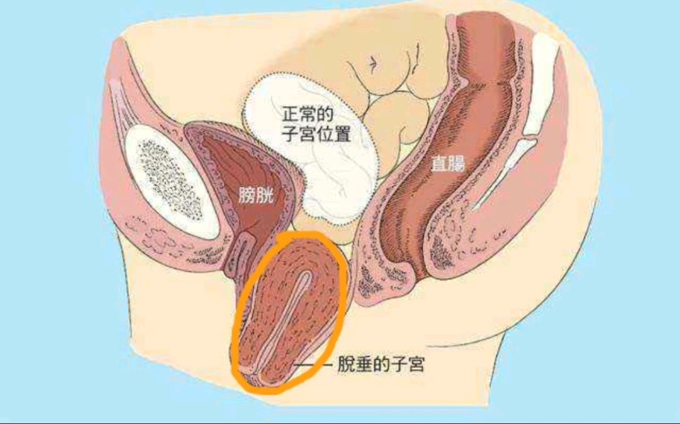 什么是子宫脱垂?哔哩哔哩bilibili