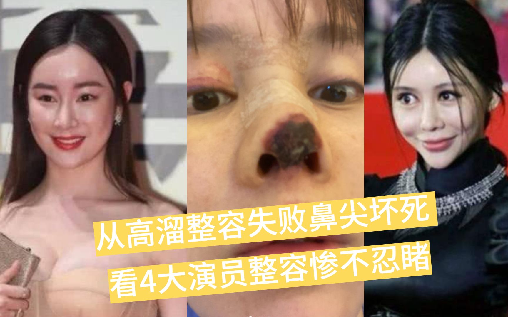 从高溜整容失败鼻尖坏死看4大演员整容惨不忍睹