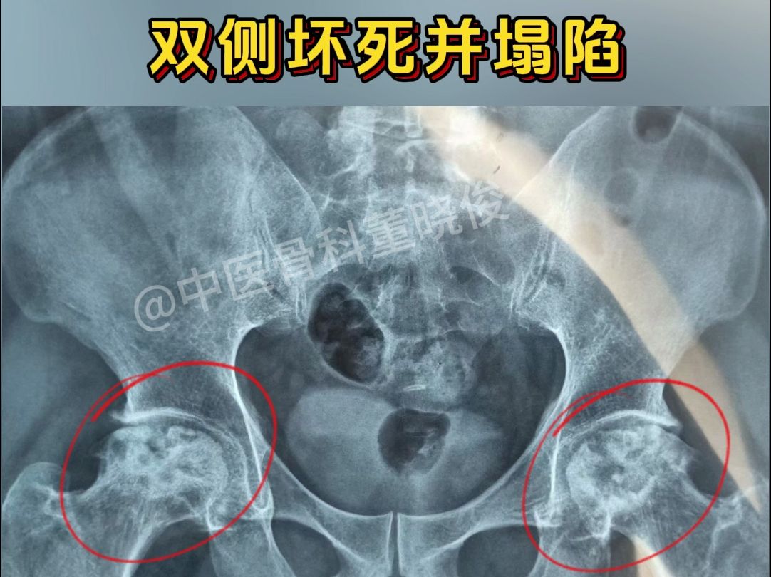 激素是股骨头坏死常见诱因之一,大家一定要注意,早发现早干预!
