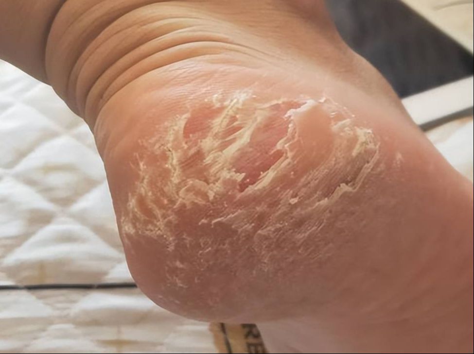 脚跟爆皮干裂一个月全好了?我的解决真的很简单!学到就是赚到!