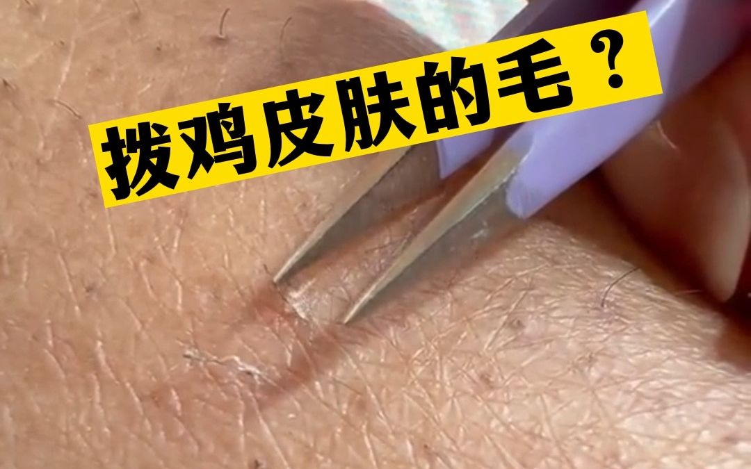 鸡皮肤扣掉(鸡皮肤可以抠掉吗)